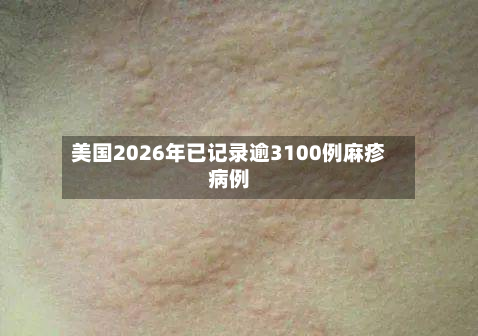 美国2026年已记录逾3100例麻疹病例-第3张图片