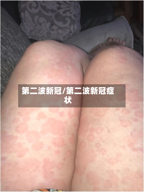 第二波新冠/第二波新冠症状-第2张图片